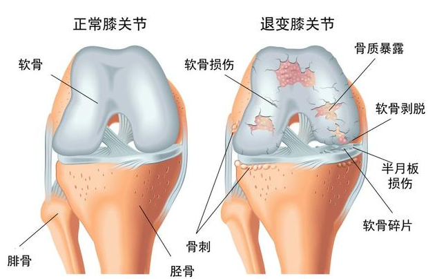 邵陽創(chuàng)傷骨科,邵陽風(fēng)濕病區(qū),邵陽骨質(zhì)增生,邵陽關(guān)節(jié)病區(qū),邵陽頸椎病區(qū)